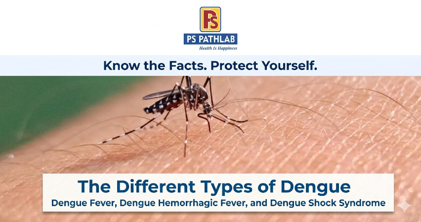 The Various Forms of Dengue: Dengue Fever, Dengue Hemorrhagic Fever, and Dengue Shock Syndrome