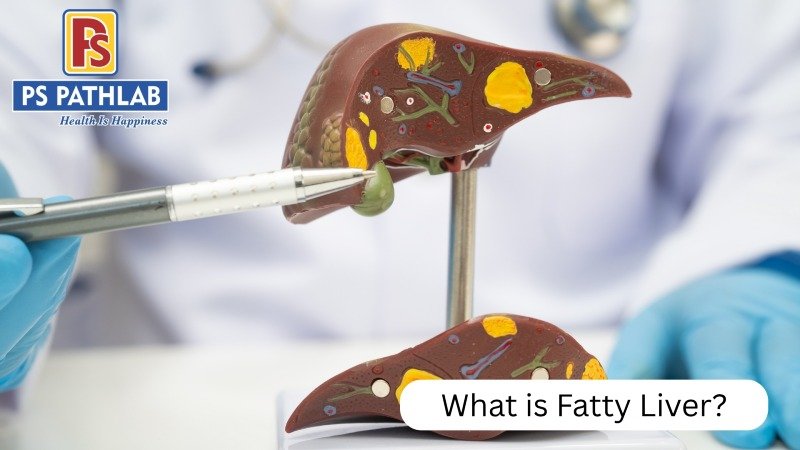 Fatty Liver Disease: From Early Detection to Effective Lifestyle Treatment
